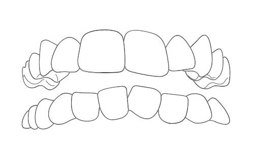 Overcrowded teeth